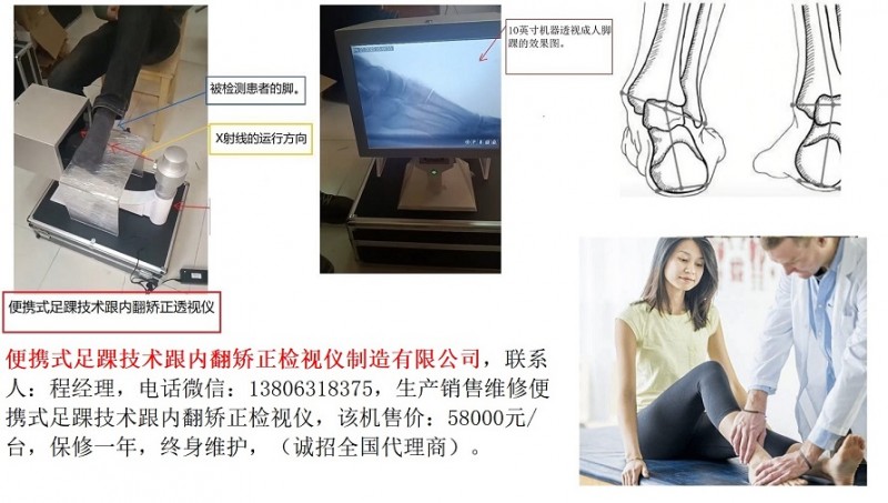 2-3-便携式足踝技术跟内翻矫正透视仪